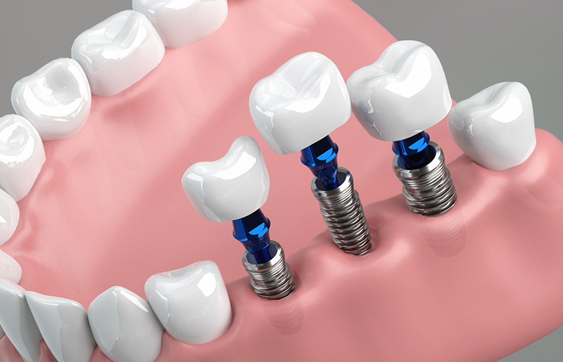 インプラントとは
